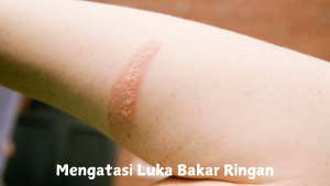 Mengatasi Luka Bakar Ringan