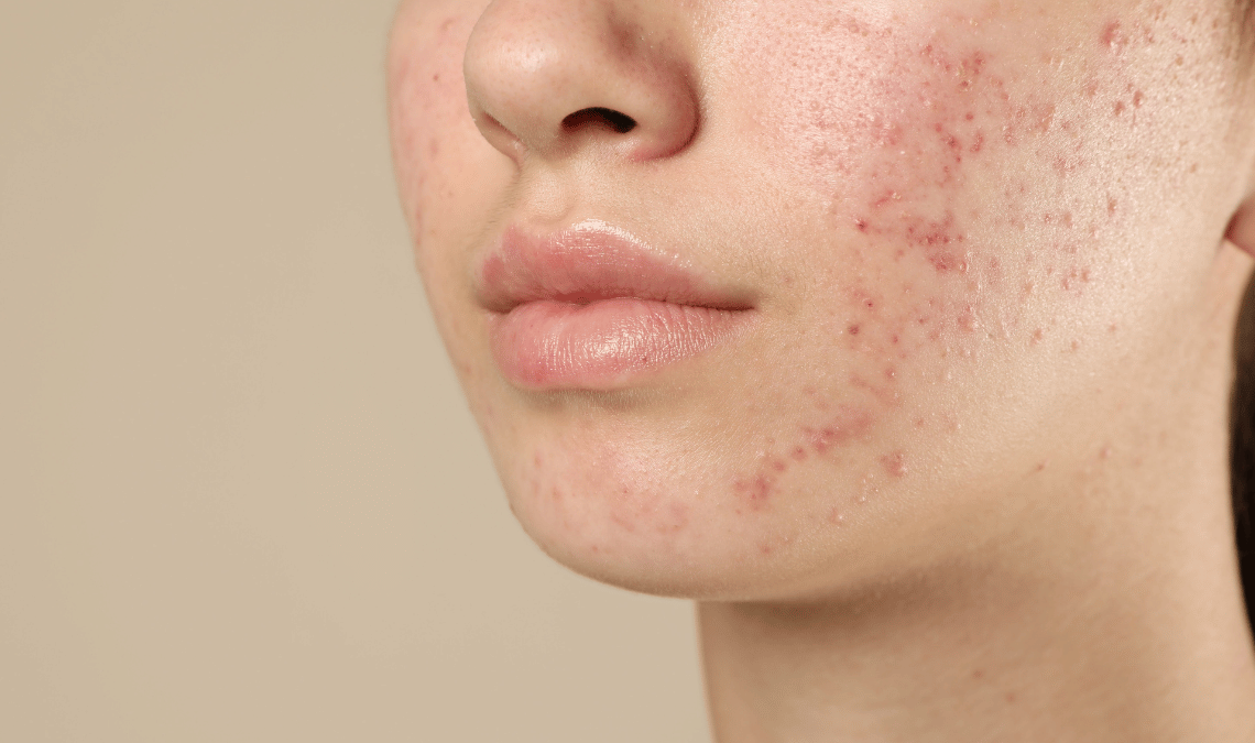 Cara Praktis Mengatasi Jerawat